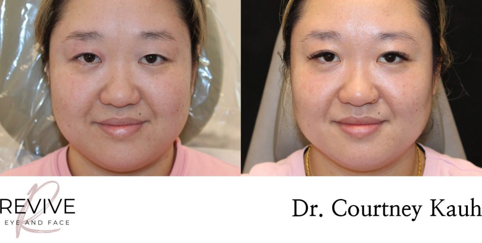 Asian Blepharoplasty