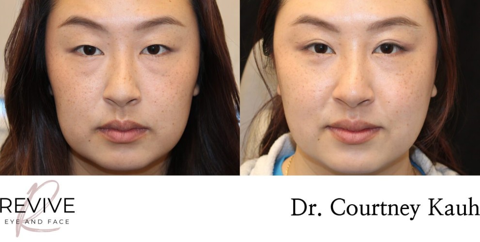 Asian Blepharoplasty