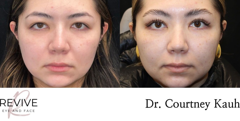 Asian Blepharoplasty