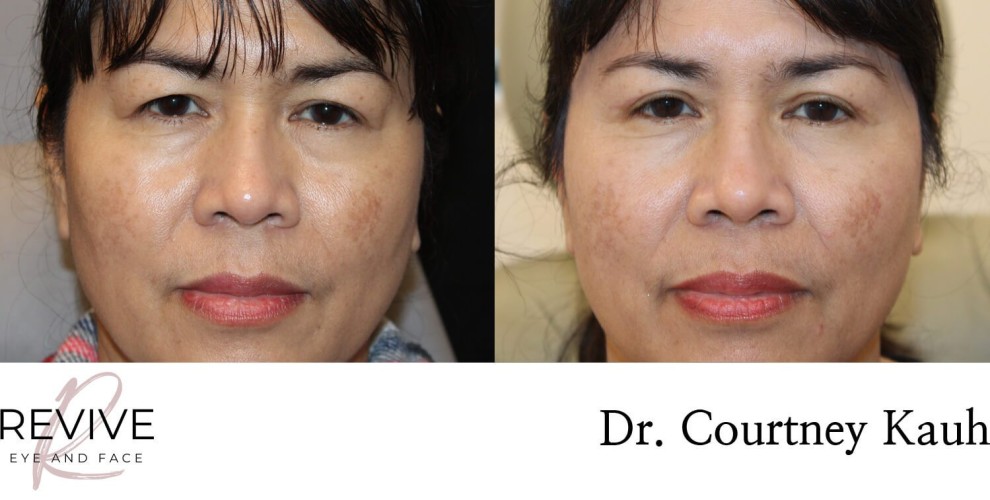 Asian Blepharoplasty
