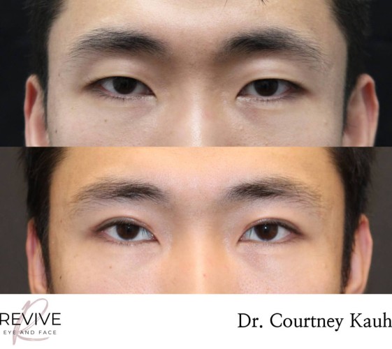Asian Blepharoplasty