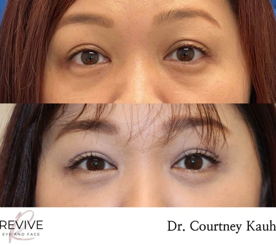 Lower Blepharoplasty