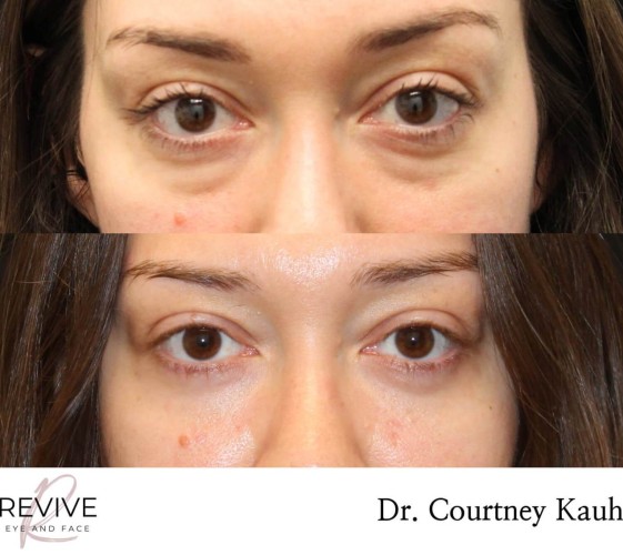 Lower Blepharoplasty