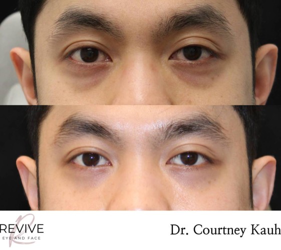 Lower Blepharoplasty