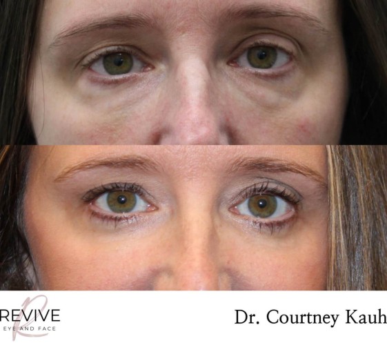 Lower Blepharoplasty