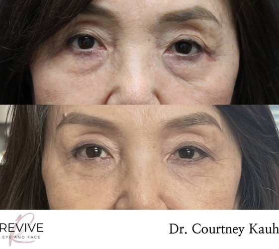 Lower Blepharoplasty