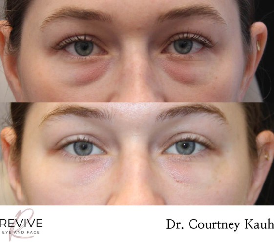 Lower Blepharoplasty