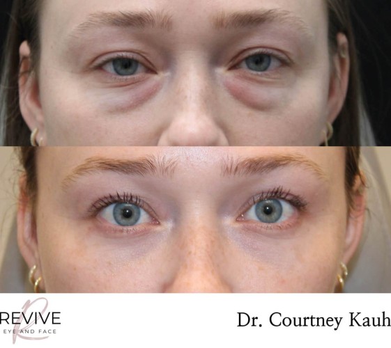 Lower Blepharoplasty