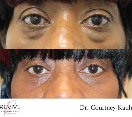 Lower Blepharoplasty
