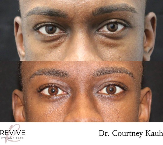 Lower Blepharoplasty