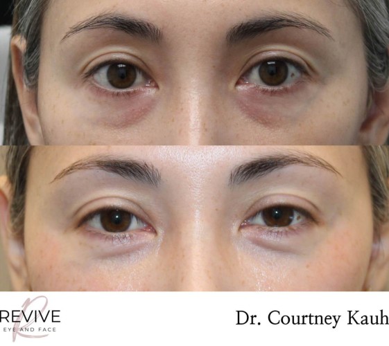 Lower Blepharoplasty