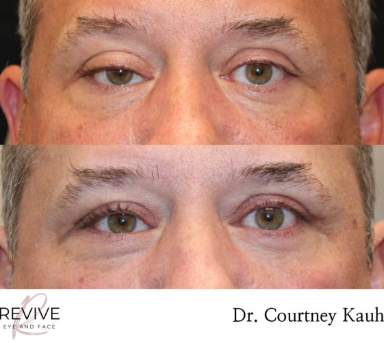1_ptosis-2