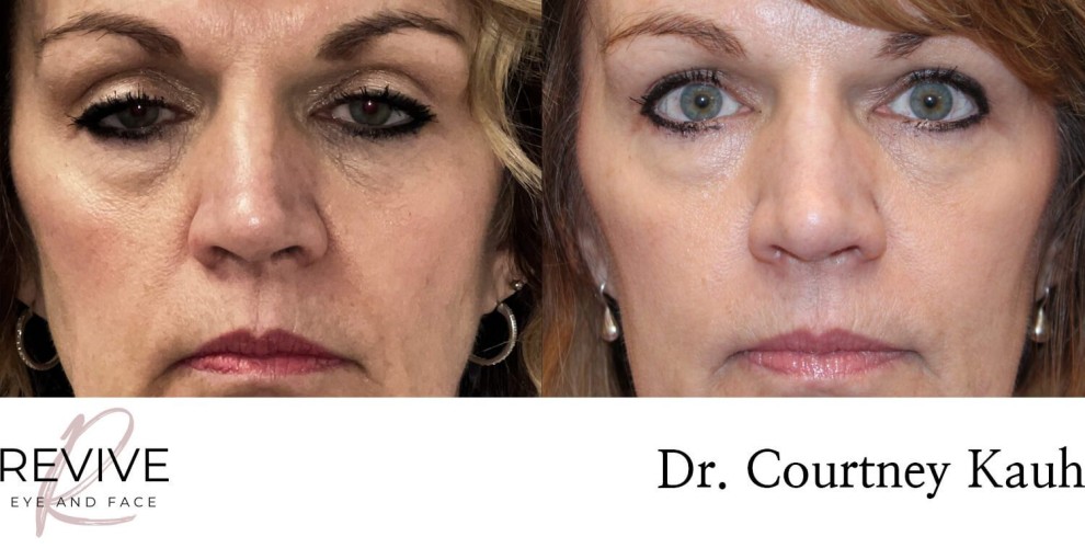 Ptosis