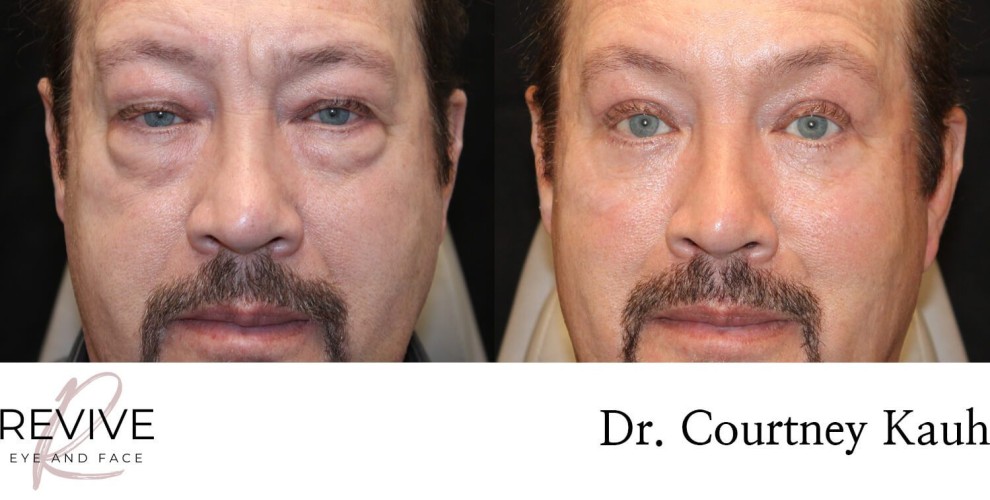 Quad Blepharoplasty