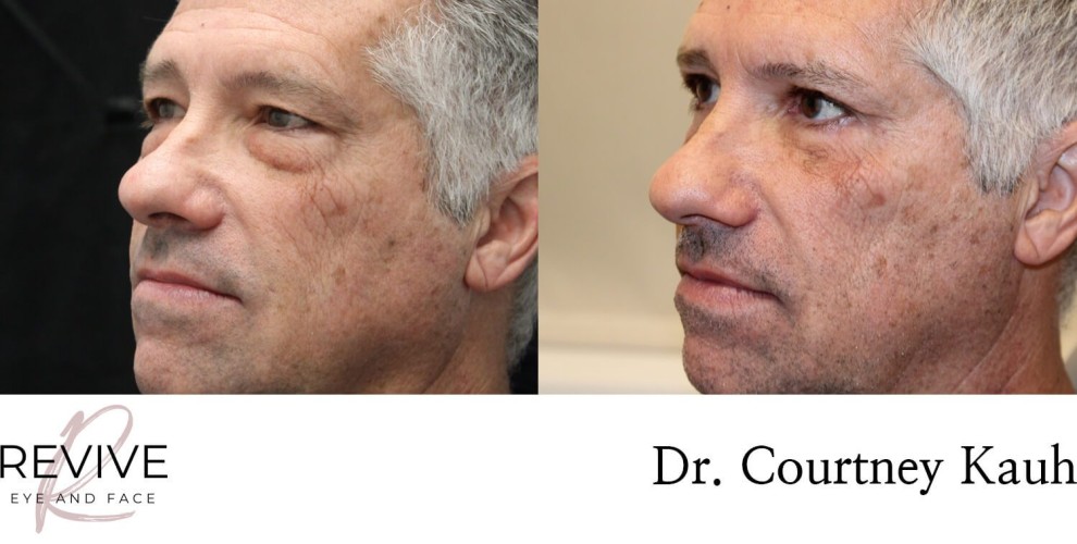 Quad Blepharoplasty