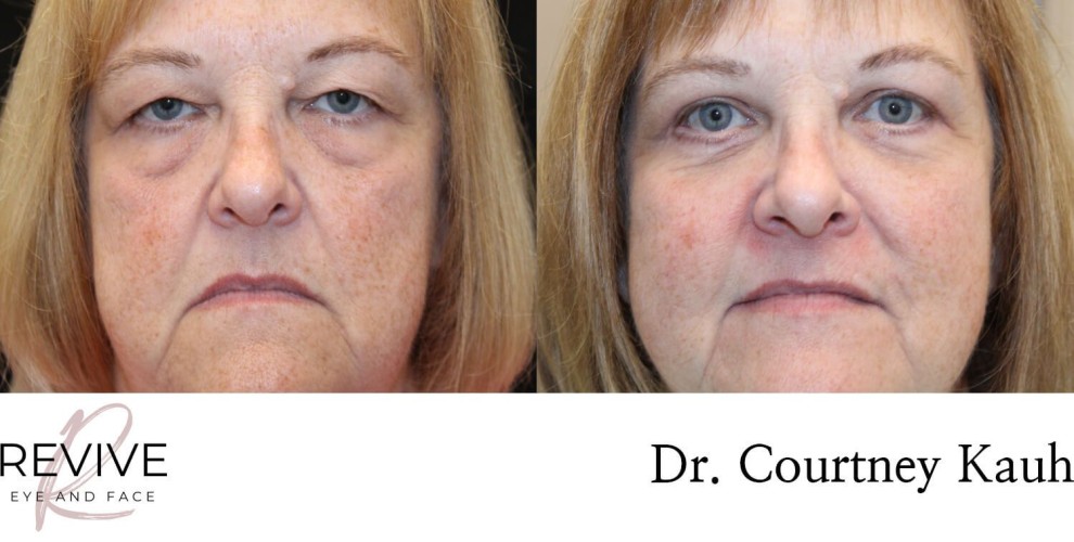 Quad Blepharoplasty