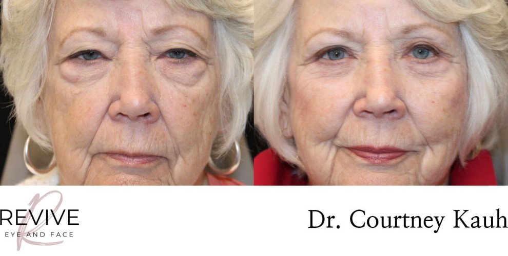 Quad Blepharoplasty