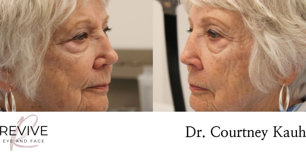 Quad Blepharoplasty