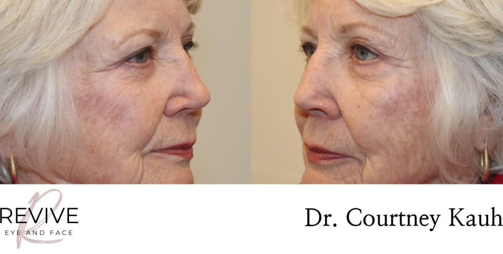 Quad Blepharoplasty