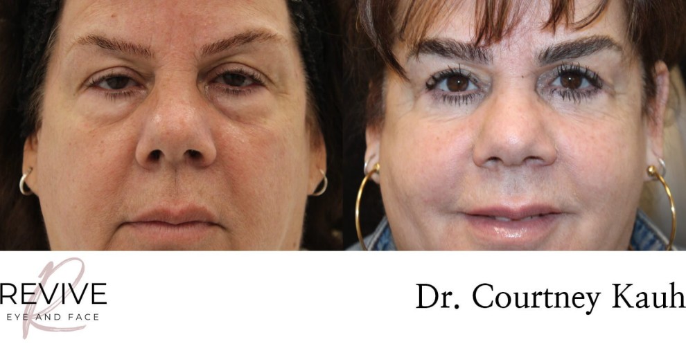 Quad Blepharoplasty