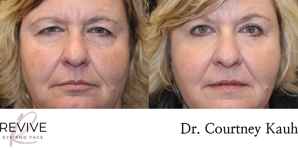 Quad Blepharoplasty