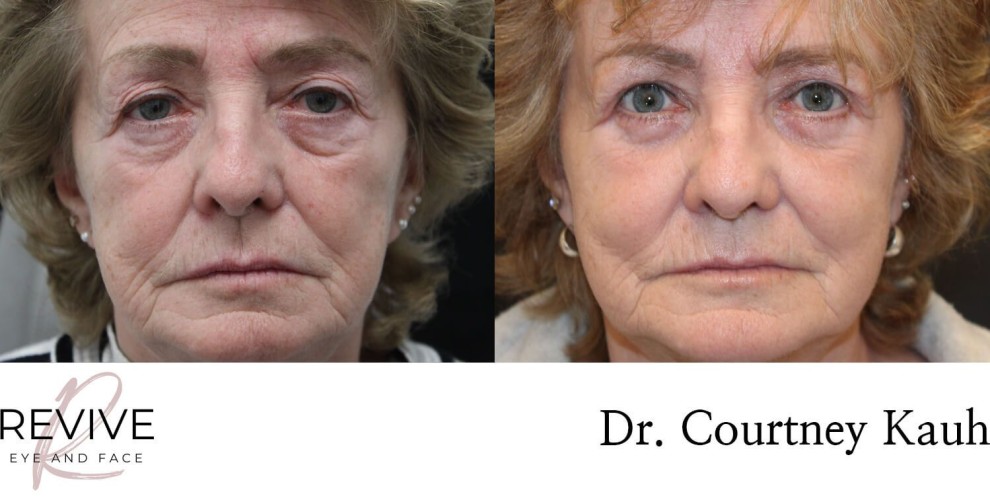 Quad Blepharoplasty