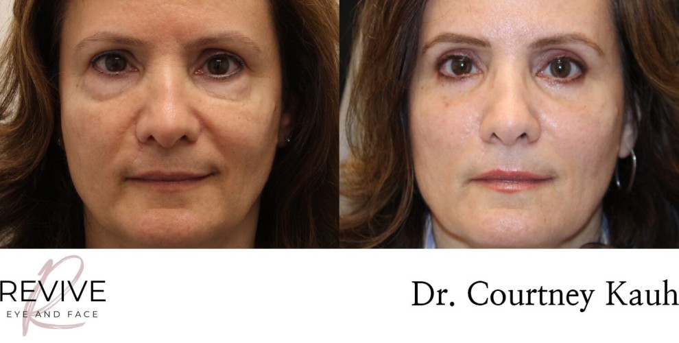 Quad Blepharoplasty