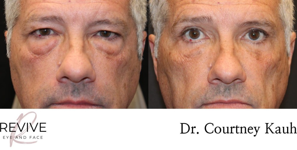 Quad Blepharoplasty
