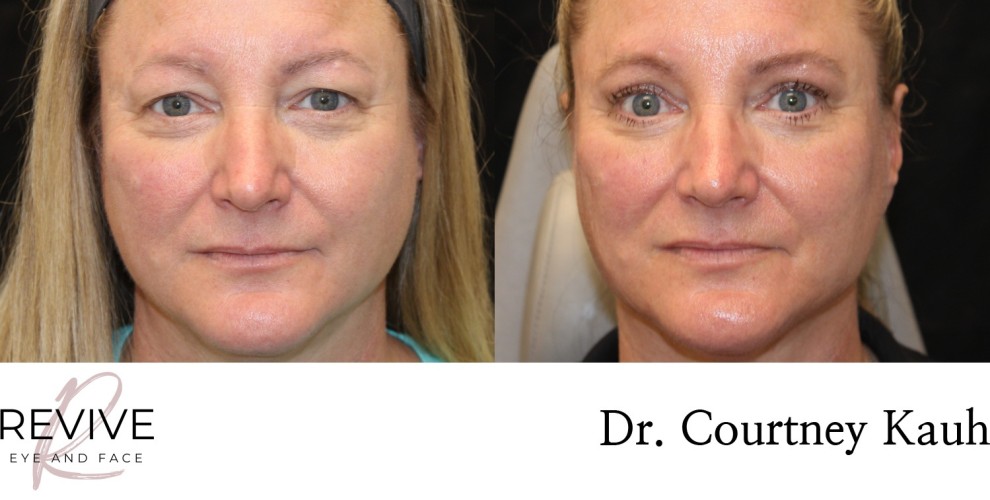 Upper Eyelid Blepharoplasty
