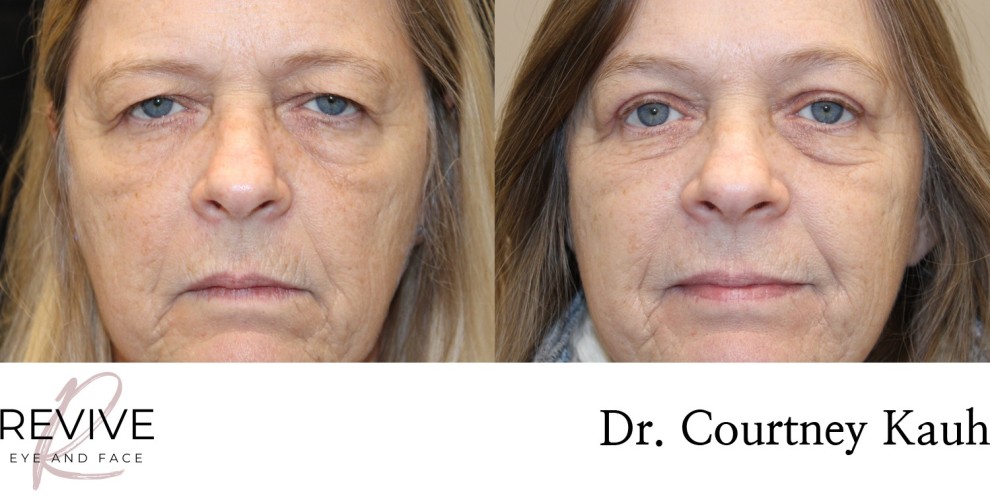 Upper Eyelid Blepharoplasty