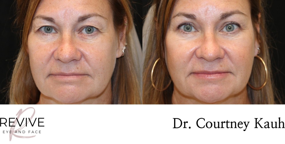 Upper Eyelid Blepharoplasty