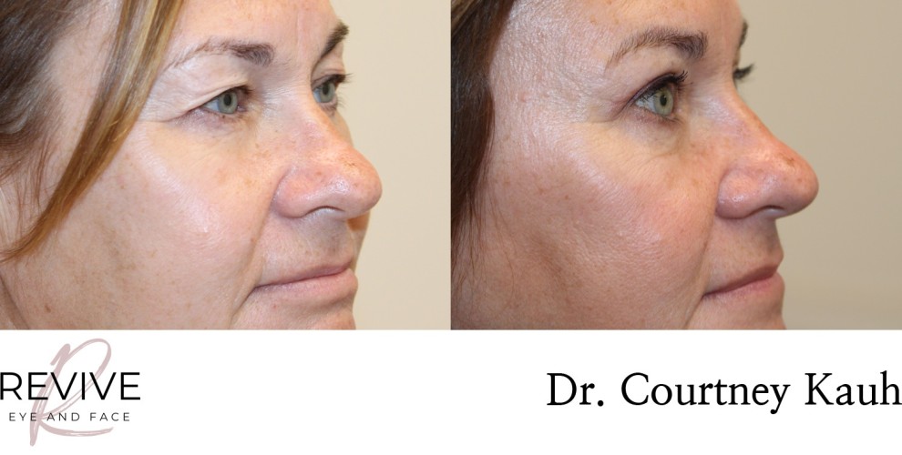 Upper Eyelid Blepharoplasty