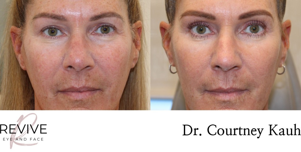 Upper Eyelid Blepharoplasty