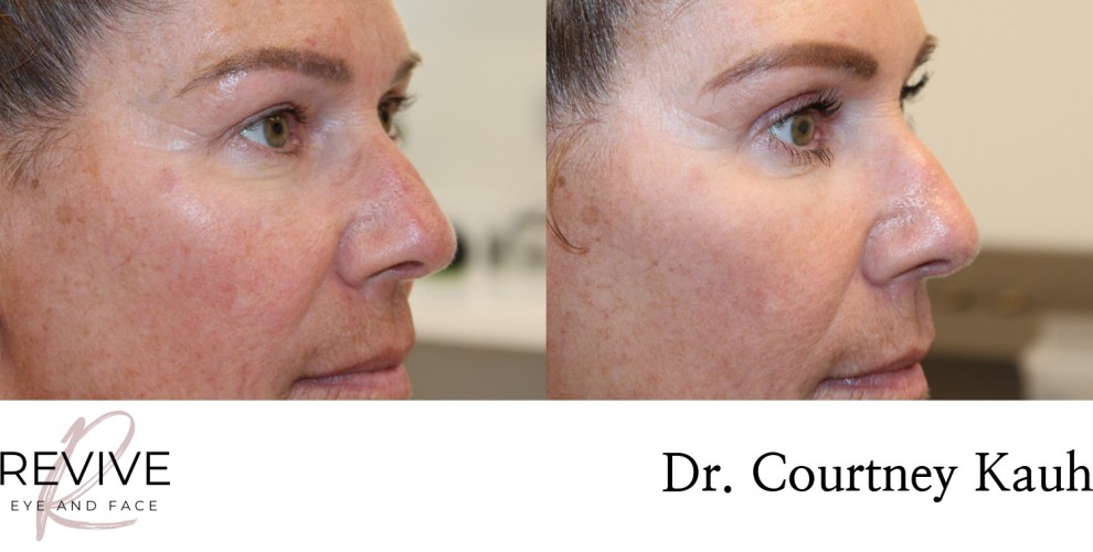 Upper Eyelid Blepharoplasty