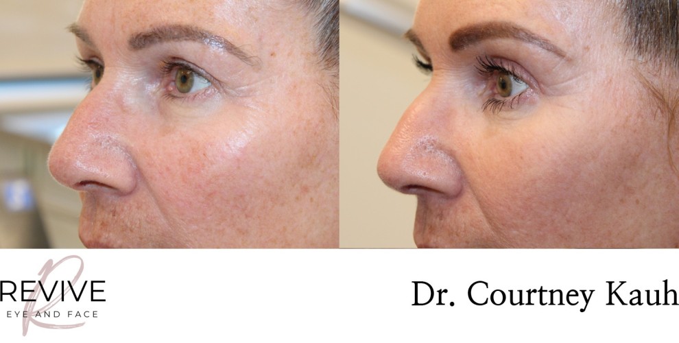 Upper Eyelid Blepharoplasty