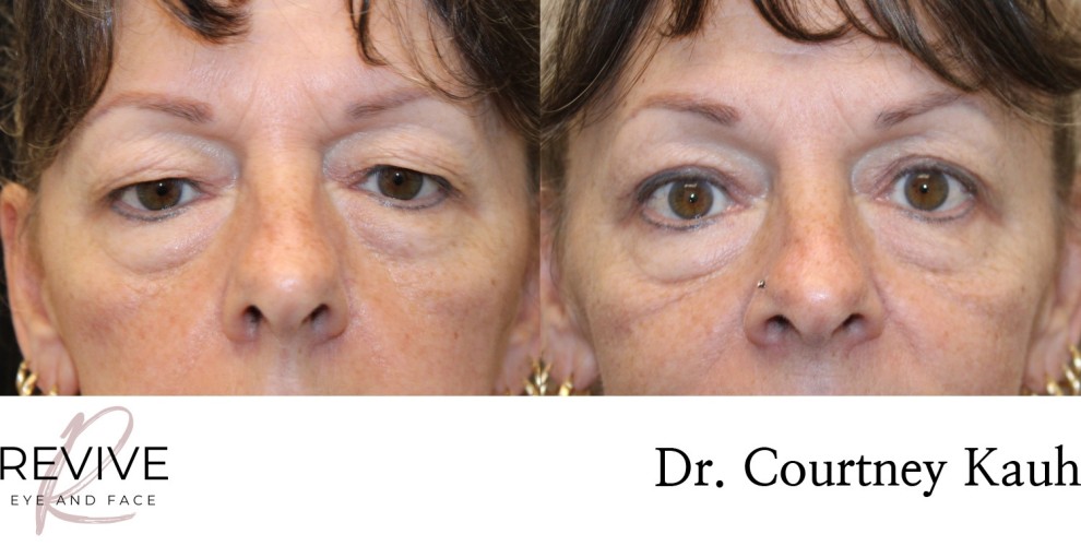 Upper Eyelid Blepharoplasty