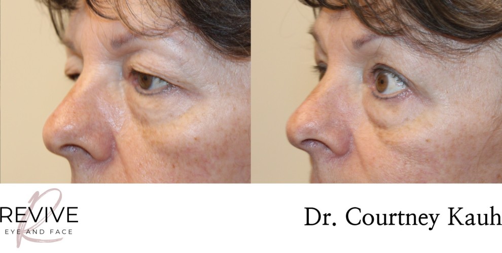 Upper Eyelid Blepharoplasty