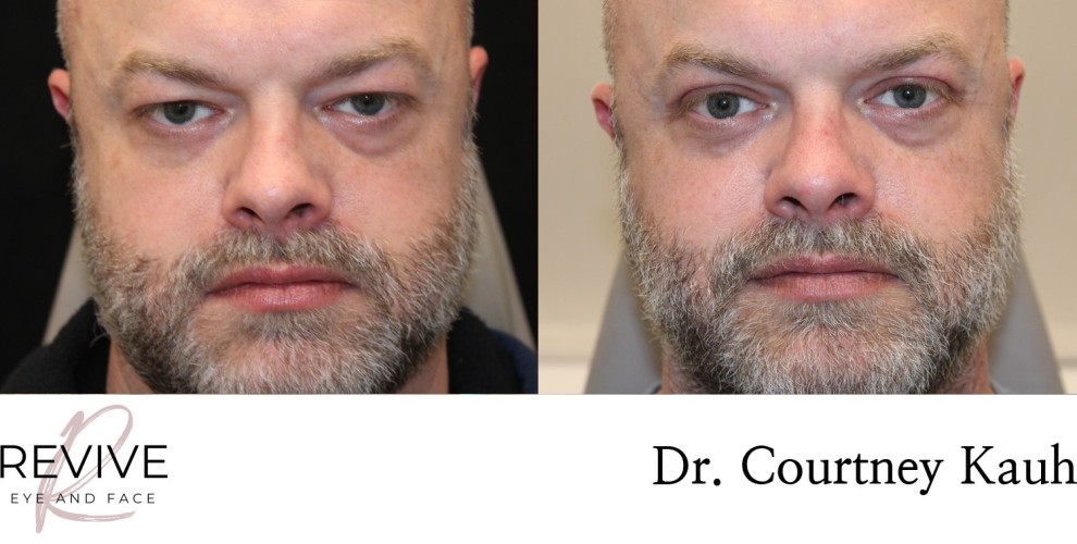 Upper Eyelid Blepharoplasty