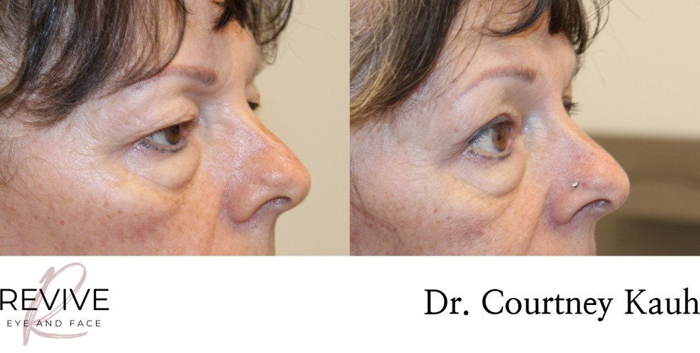 Upper Eyelid Blepharoplasty