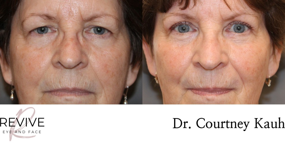 Upper Eyelid Blepharoplasty