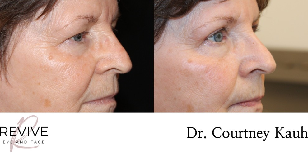 Upper Eyelid Blepharoplasty