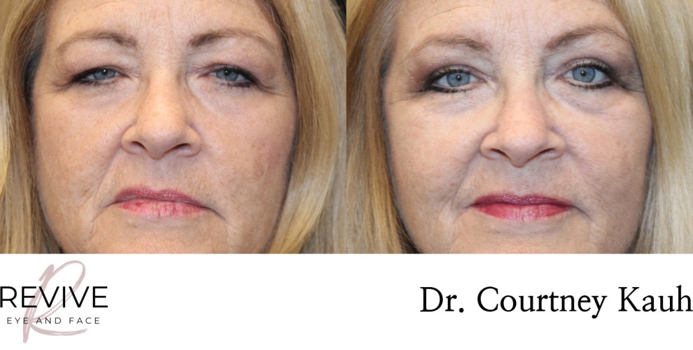 Upper Eyelid Blepharoplasty