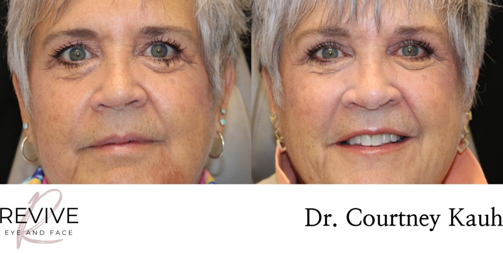 Upper Eyelid Blepharoplasty