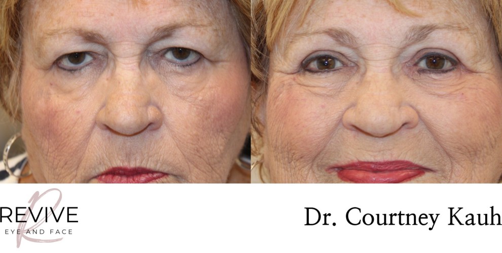 Upper Eyelid Blepharoplasty