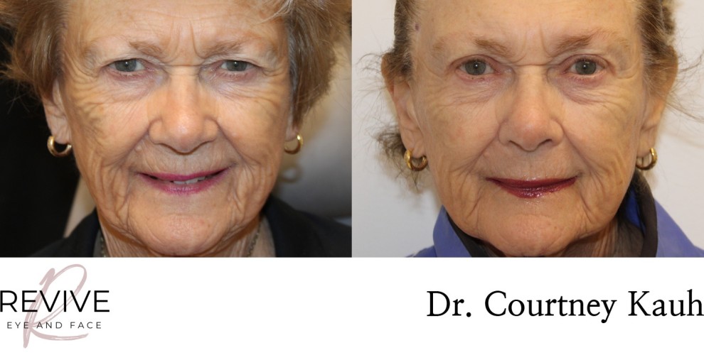 Upper Eyelid Blepharoplasty