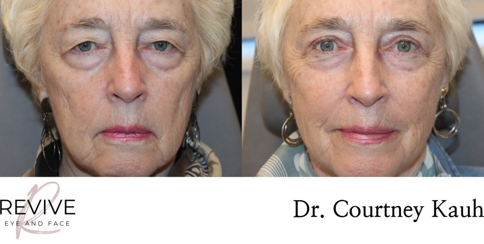 Upper Eyelid Blepharoplasty