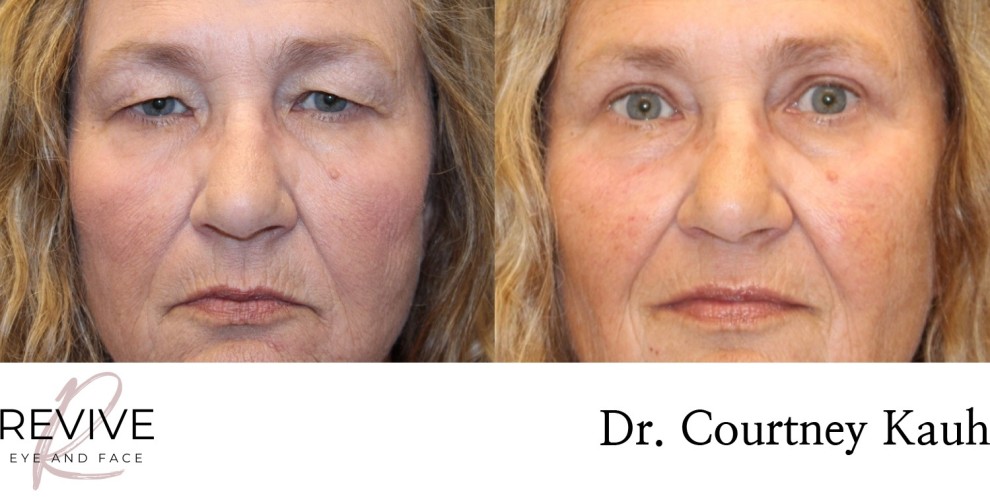 Upper Eyelid Blepharoplasty