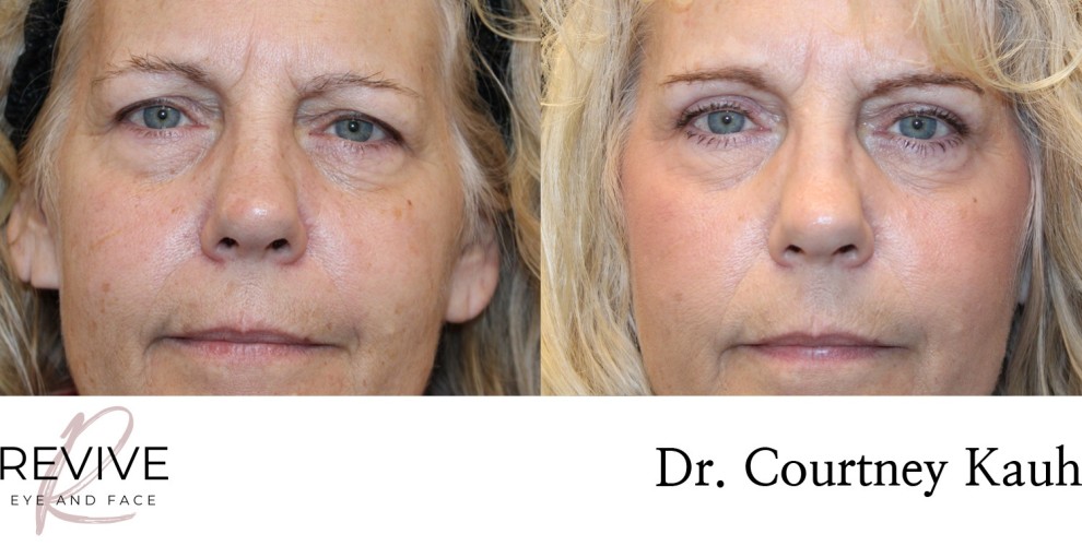 Upper Eyelid Blepharoplasty