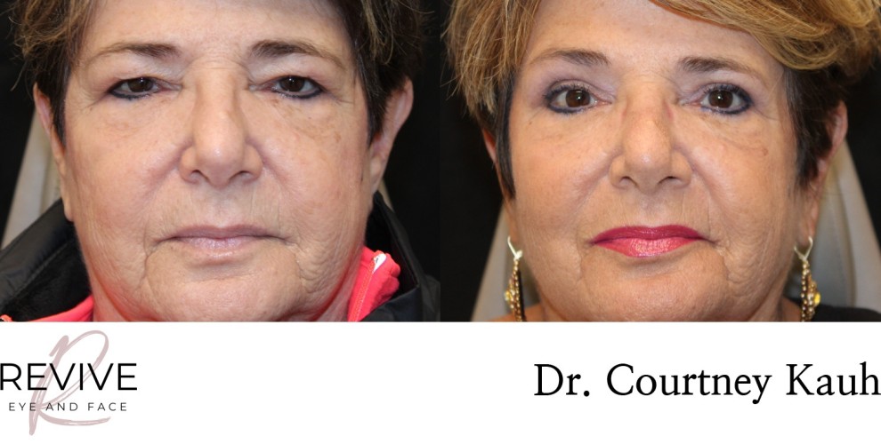 Upper Eyelid Blepharoplasty