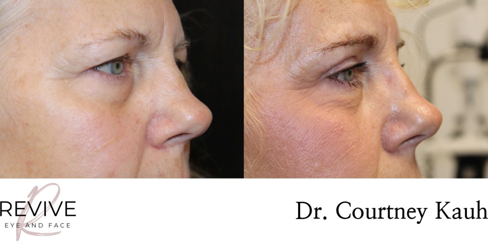Upper Eyelid Blepharoplasty